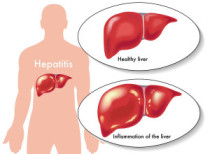 New medicine for Hepatitis C treatment launched