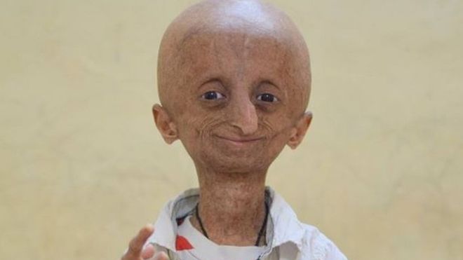 Nihal Bitla: India progeria campaigner dies aged 15