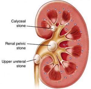 Kidney-Stones-in-Men-300x296