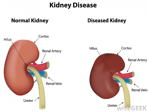 labeled-illustration-of-kidney-disease